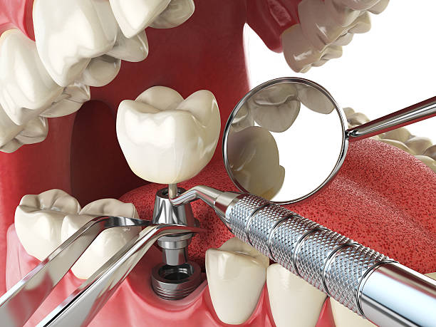 Best Knocked-Out Tooth Emergency  in Coshocton, OH